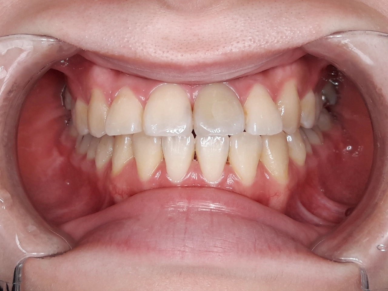 ウォーキングブリーチ