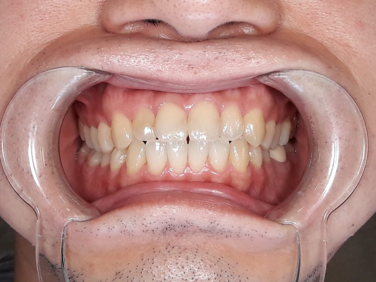 ホワイトニング