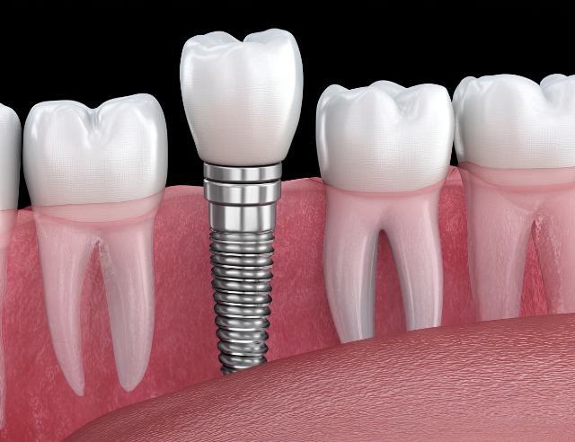 インプラント治療の口腔内イメージ