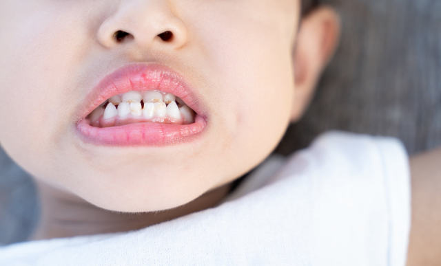 受け口の子どもの口もとのイメージ