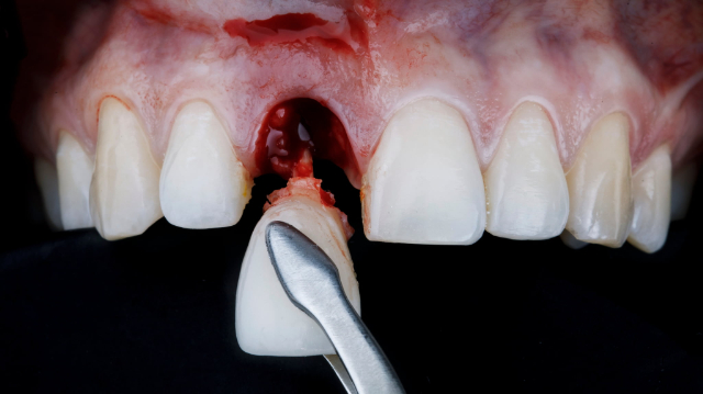 歯周病が進行して抜歯をしているイメージ