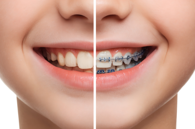 ワイヤー矯正をする子供の口元