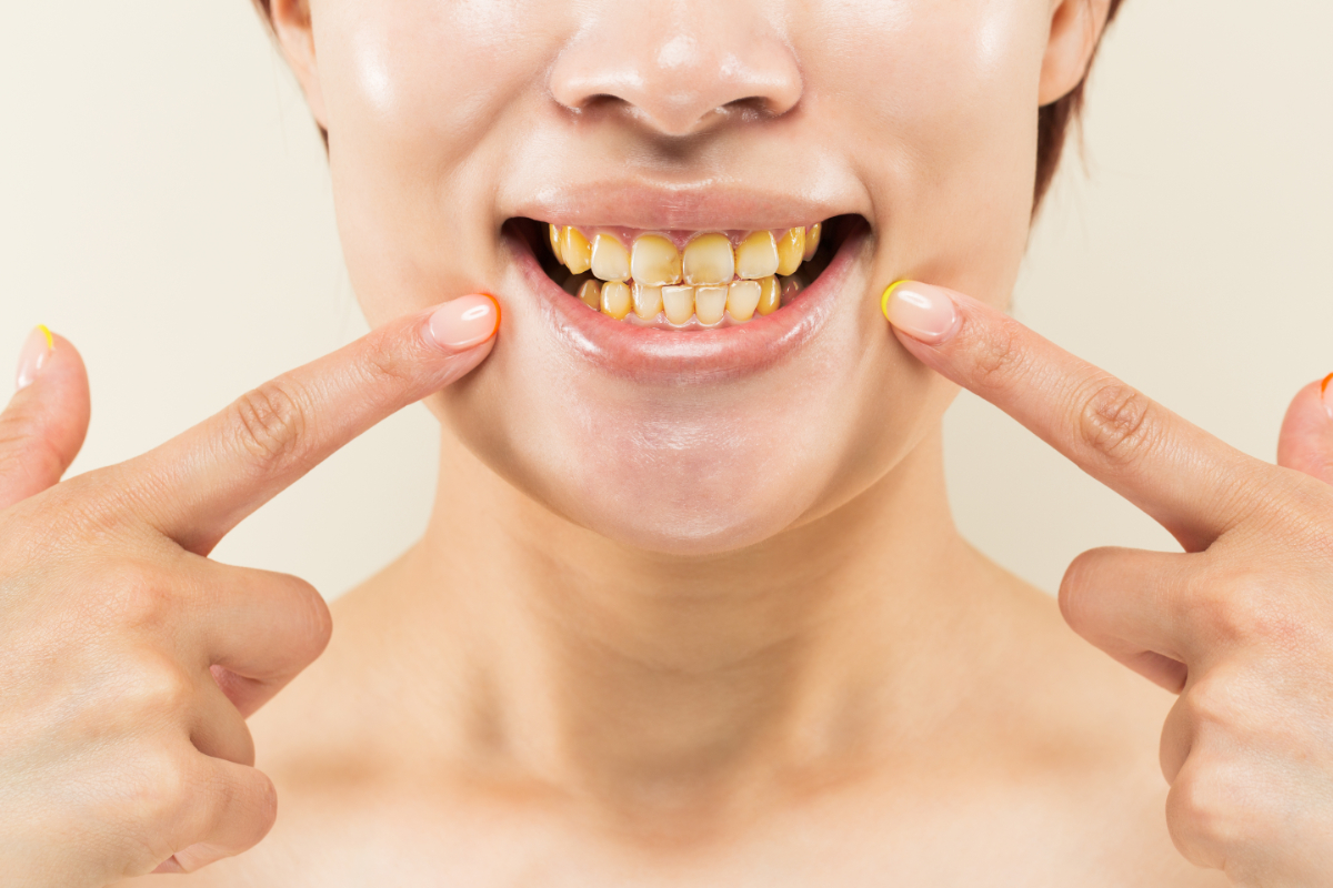 喫煙で黄ばんだ歯を指さす様子